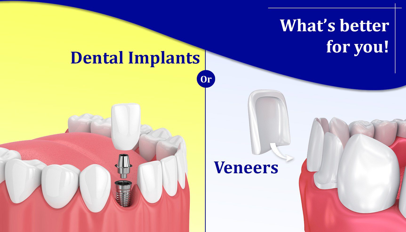You are currently viewing Dental Implants or Veneers (Pros & Cons): What’s better for you!