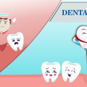 Read more about the article Top 5 Benefits of Dental Implants