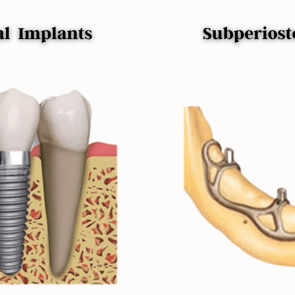 Endosteal Subperiosteal Implants - Dental Implant Dentist