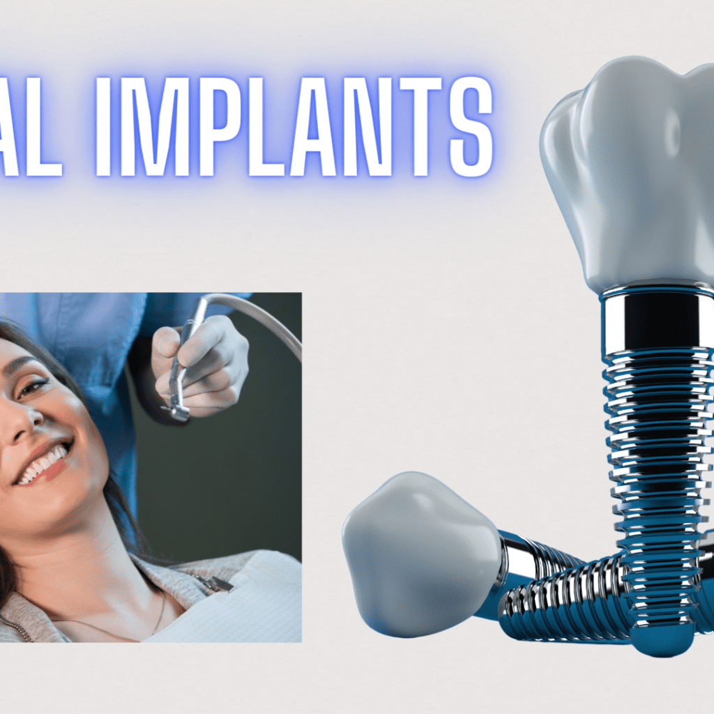 Let's Learn About The NittyGritty Of Dental Implants!