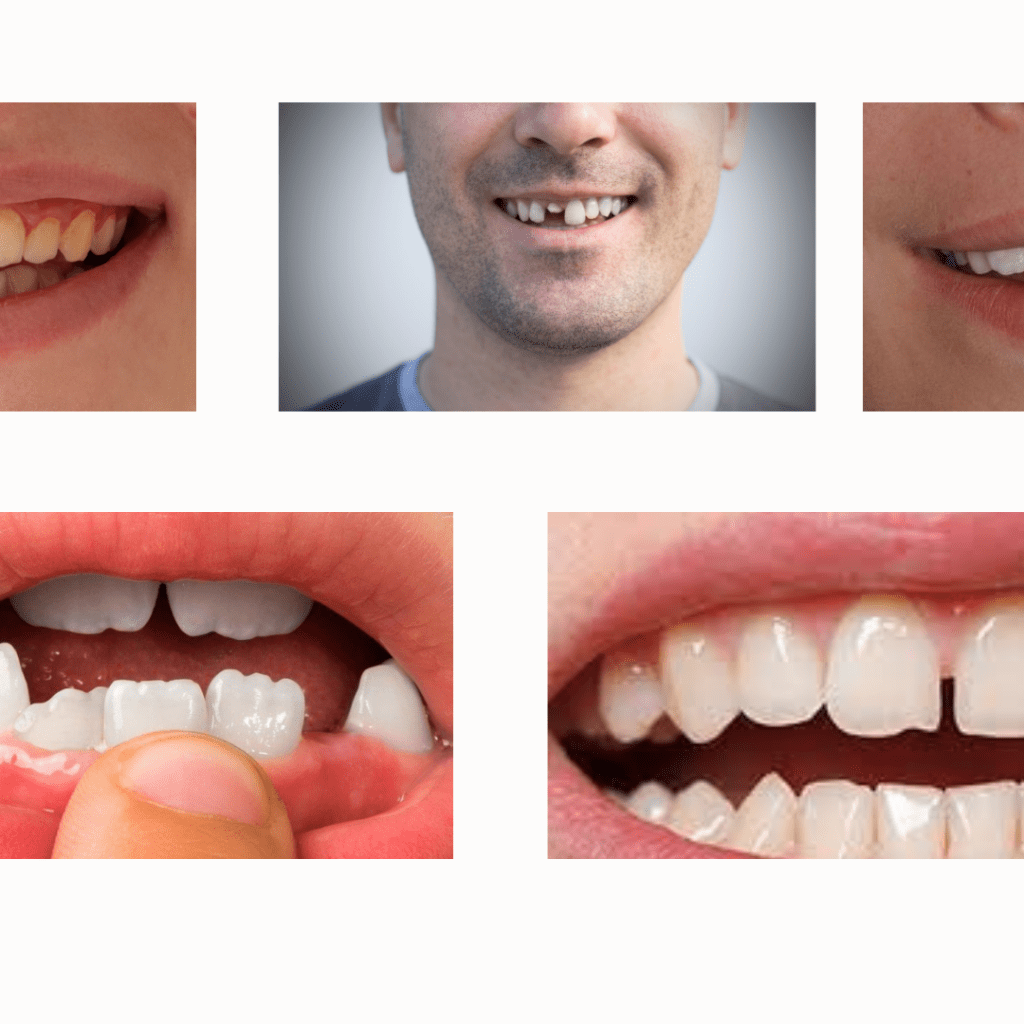 Porcelain or Composite Veneers
