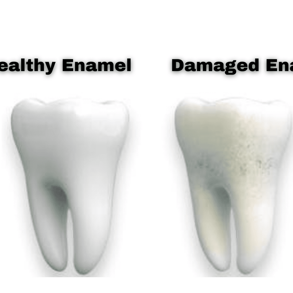 What is Enamel Erosion