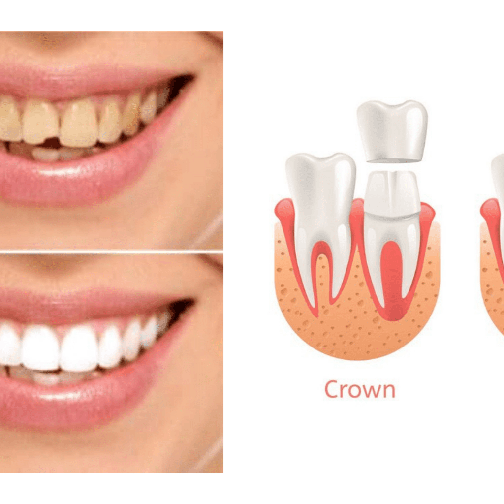 crown veneer