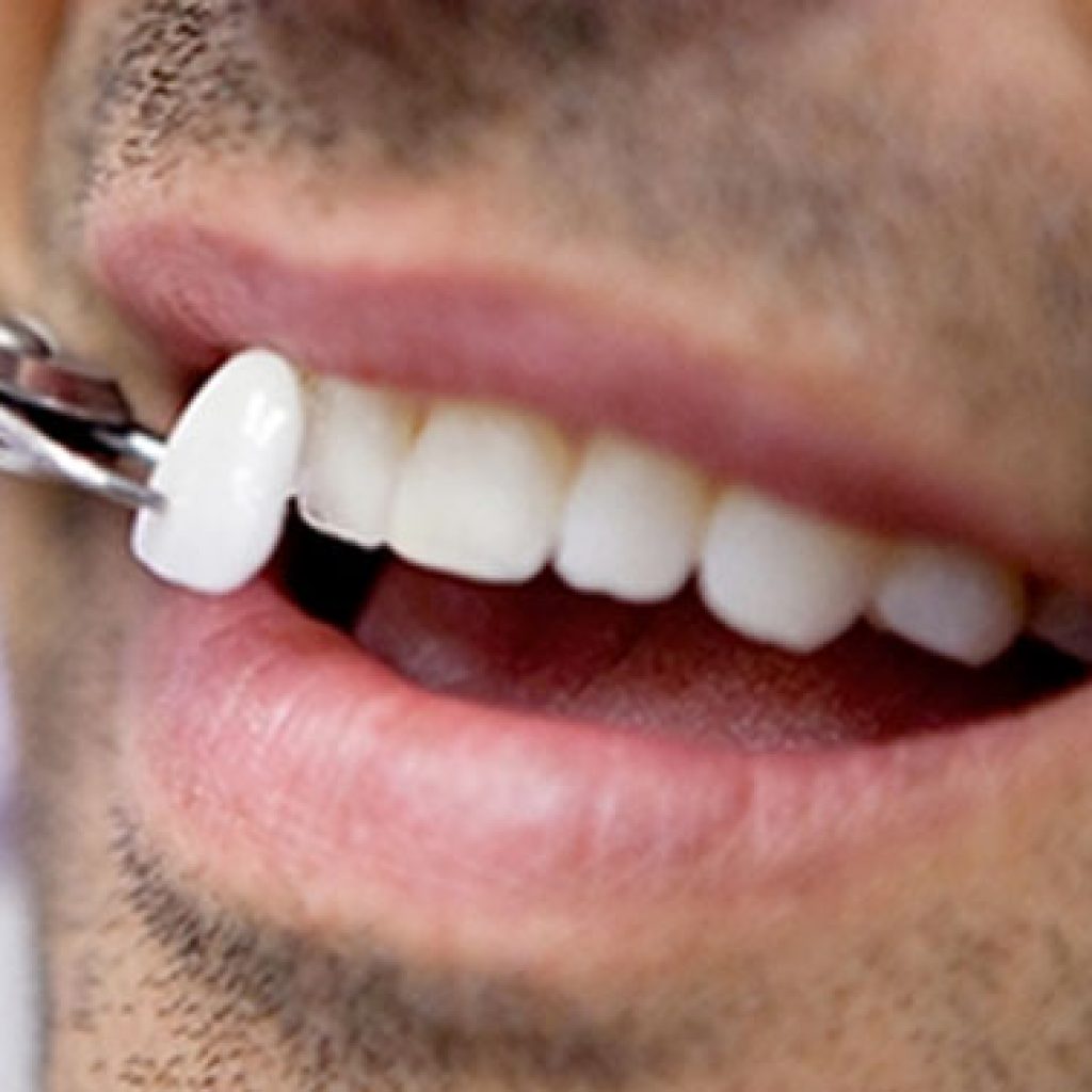 porcelain-veneers