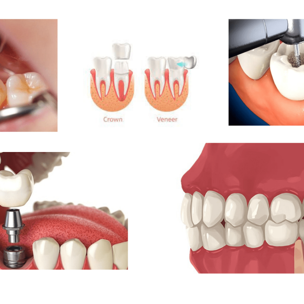 Cavity Filling