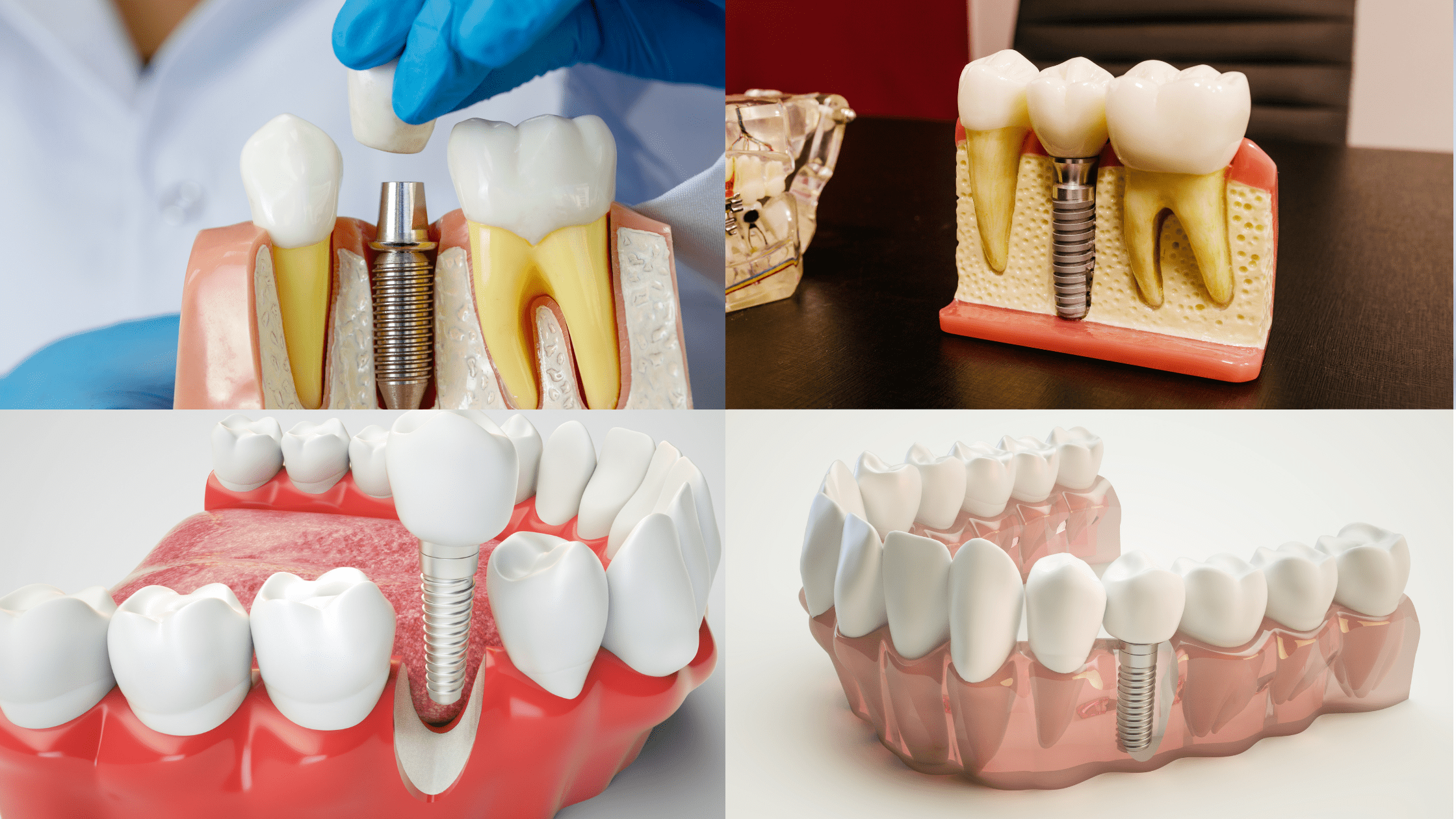Dental Implant Benefits