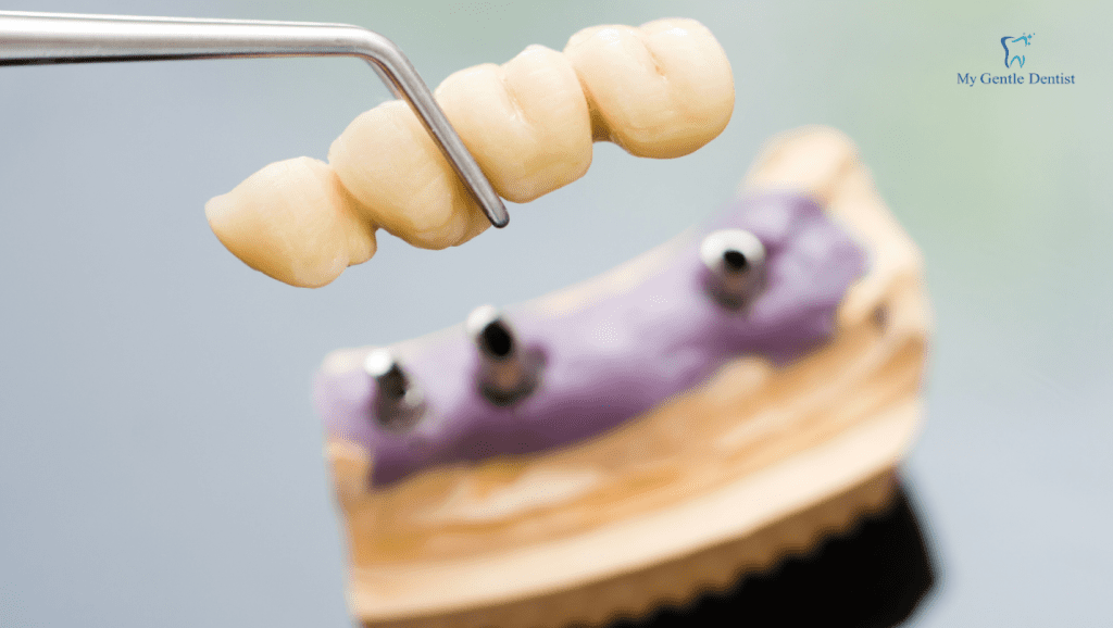 A bridge is another option if you're missing multiple teeth