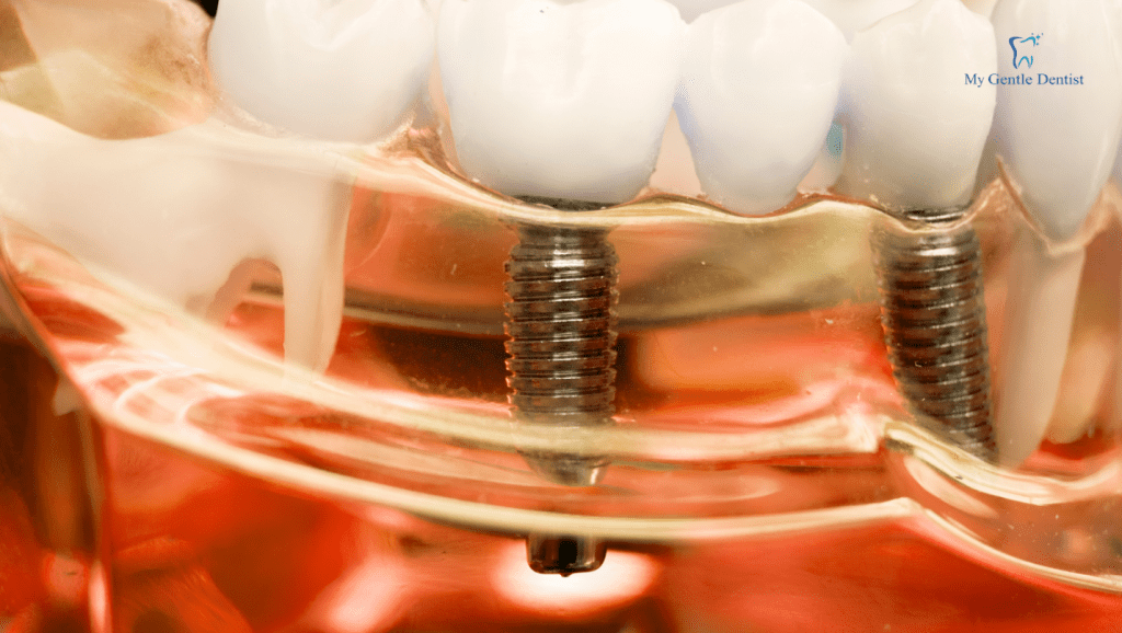 5 Best Tooth Replacement Options for When You Lose a Tooth