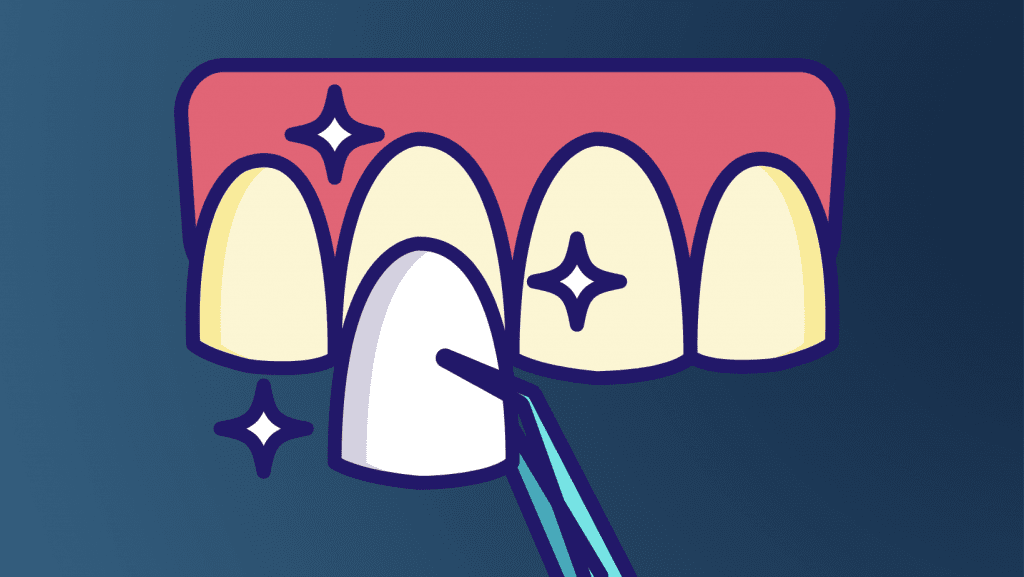 What dental veneers are and how they're used to improve smiles