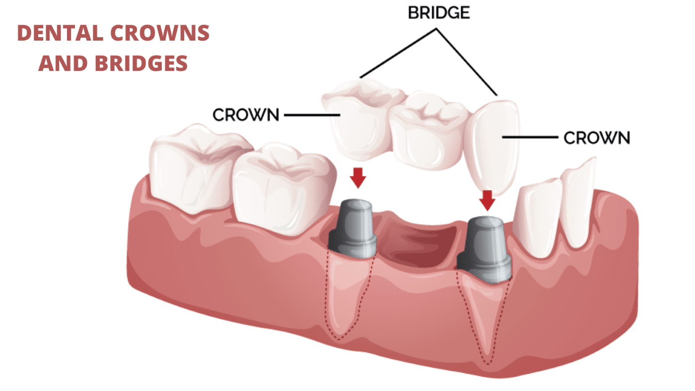 What Are Dental Crowns And Bridges?