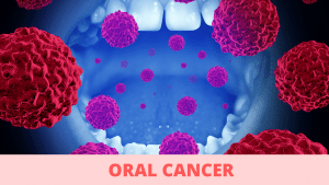 Read more about the article Oral Cancer: The Symptoms You Need to Know, and How to Prevent It