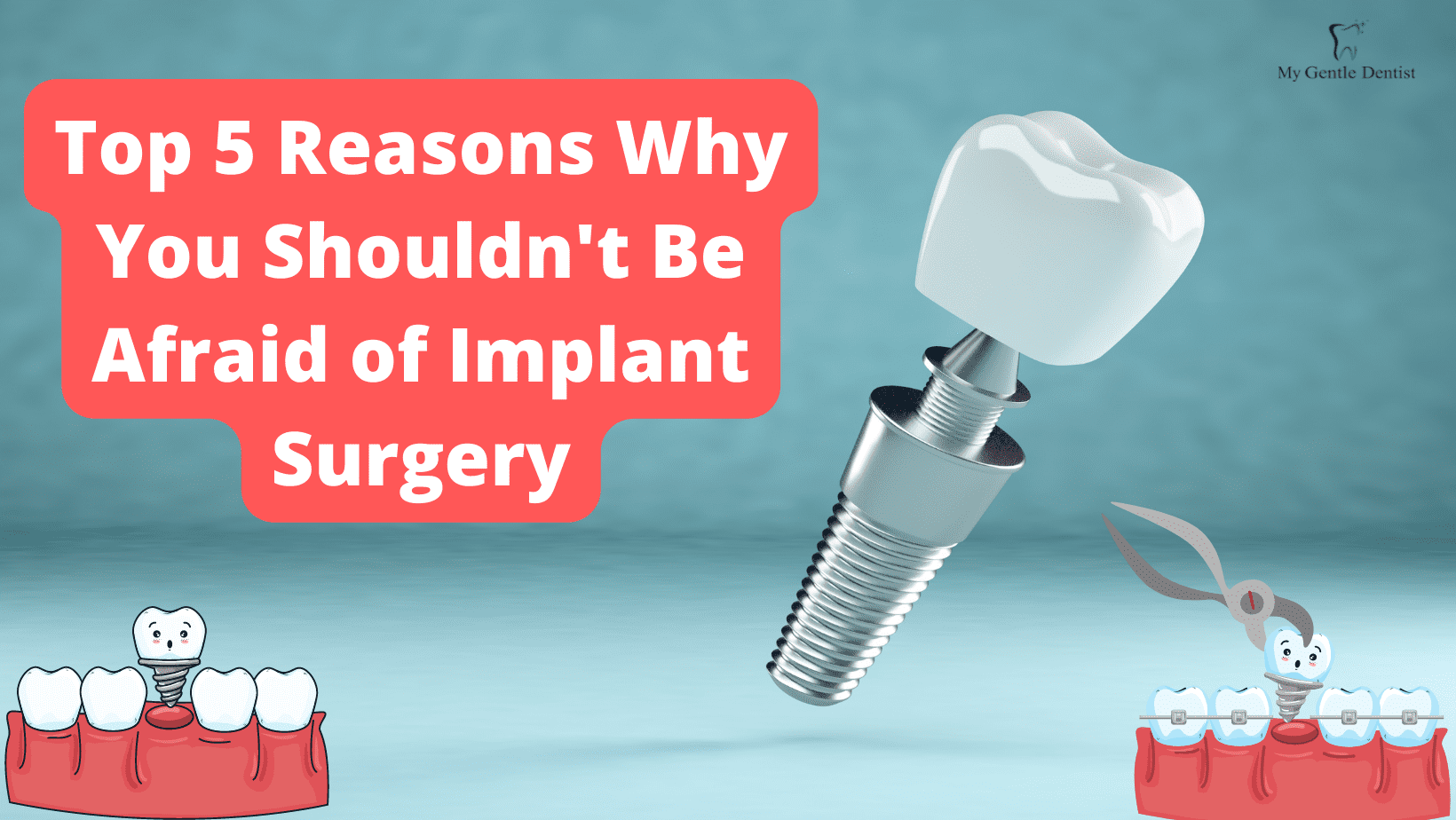 You are currently viewing The Top 5 Reasons Why You Shouldn’t Be Afraid Of Implant Surgery