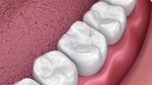 Read more about the article Why Dental Fillings Are Essential for Oral Health